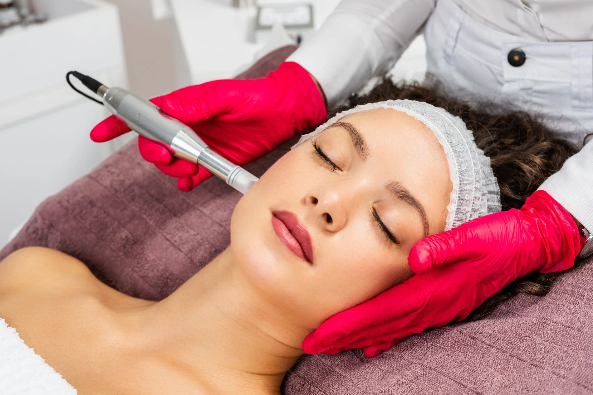 Microneedling in Burlington, ON